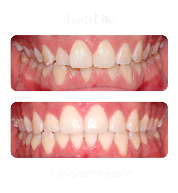 Deep Bite 1