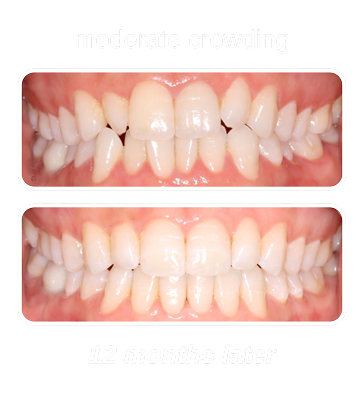 Moderate Crowding 1