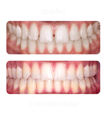 Spacing 1