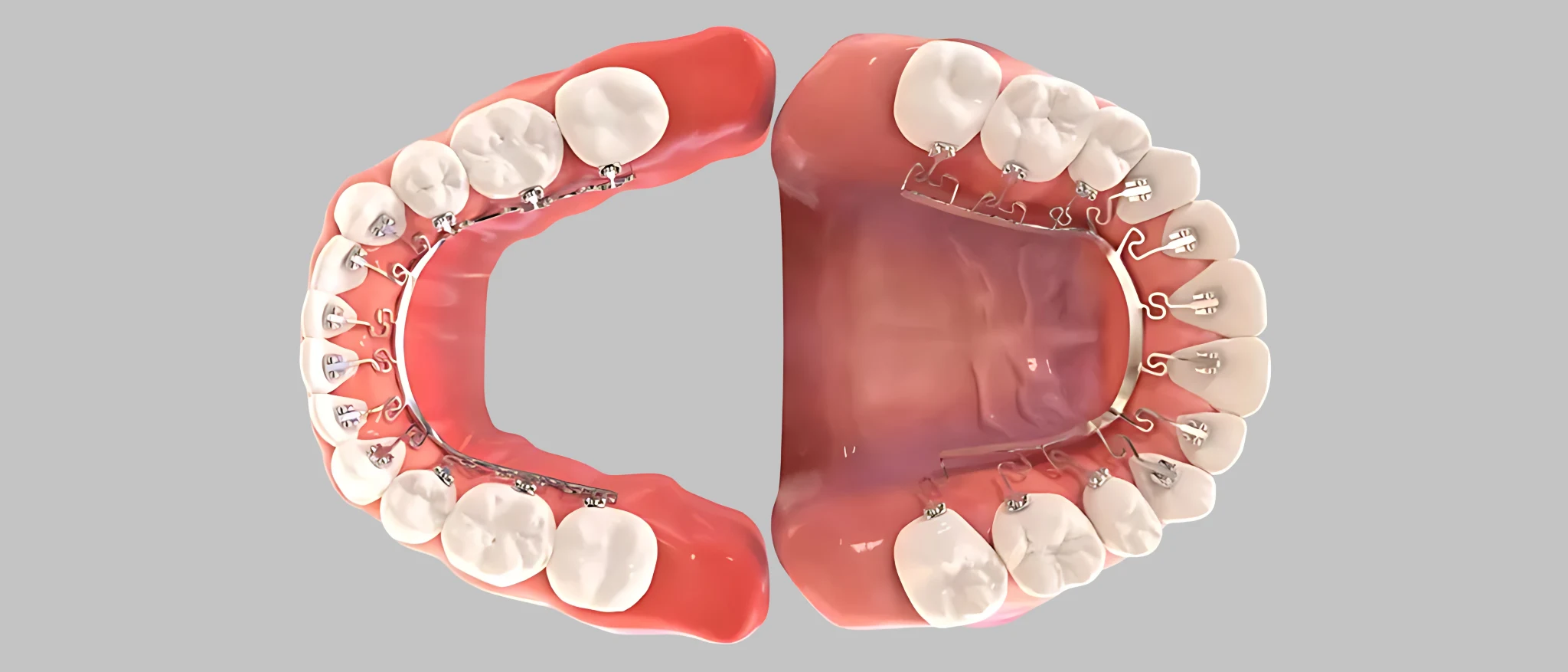 Do braces hurt