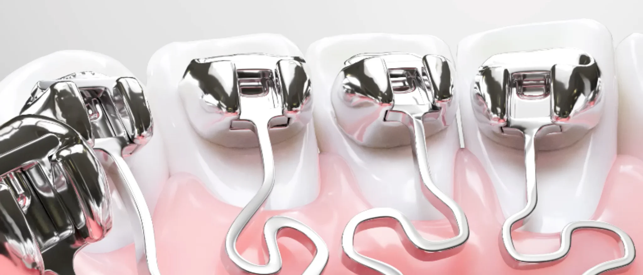 How Long Do Braces Take