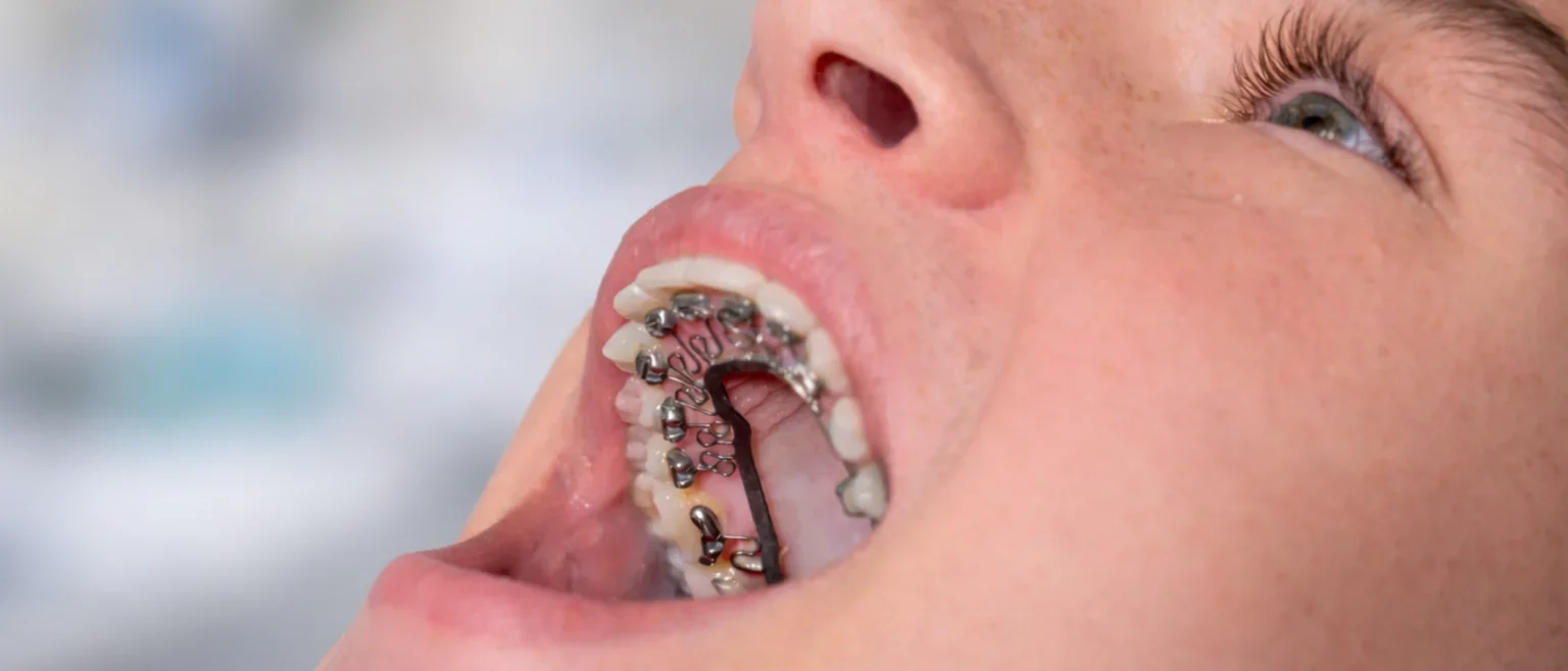 braces for teenagers