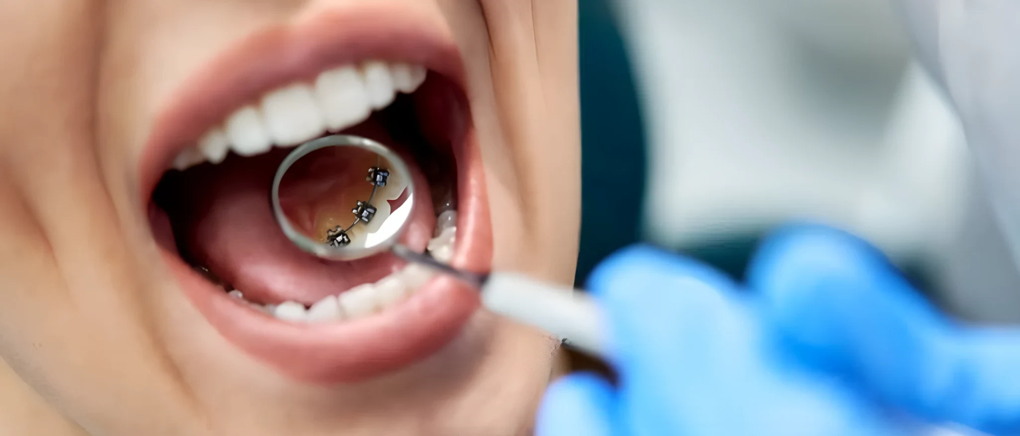how much do braces cost