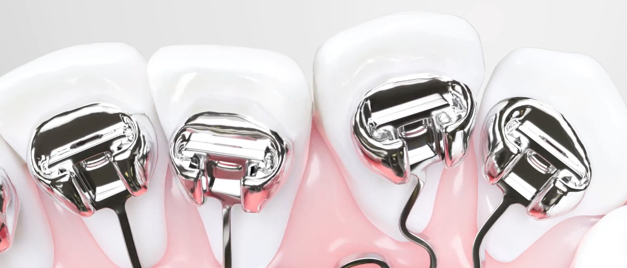 How to choose braces