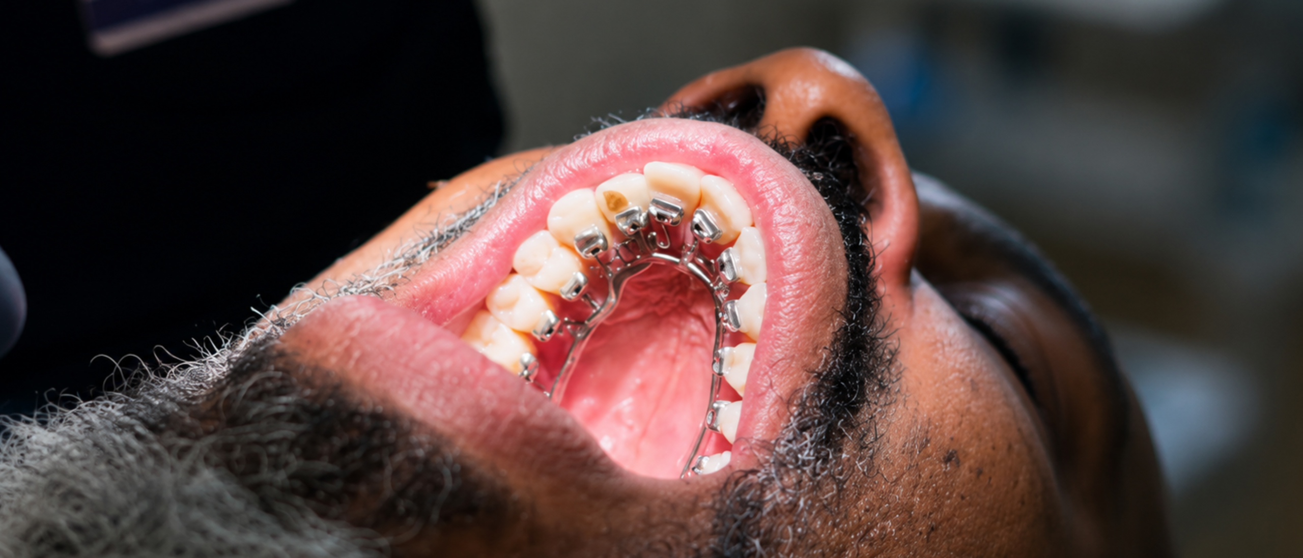 Are invisible braces worth it