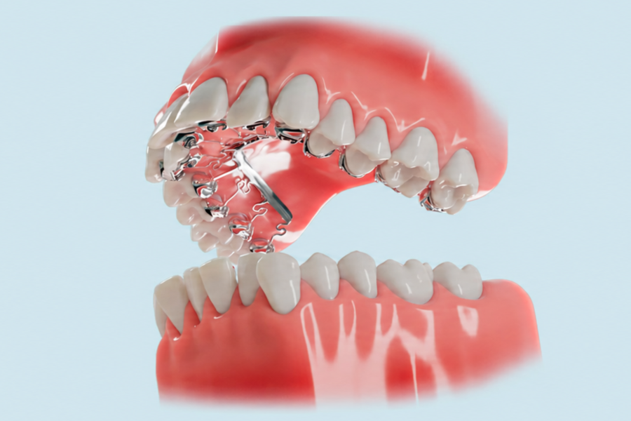 Are invisible braces worth it